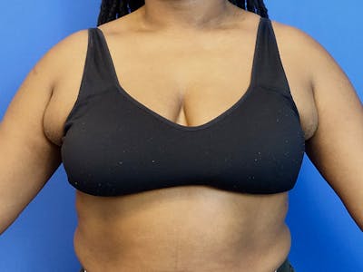 Axillary Breast Removal Before & After Gallery - Patient 112338655 - Image 1