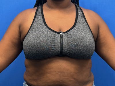 Axillary Breast Removal Before & After Gallery - Patient 112338655 - Image 2