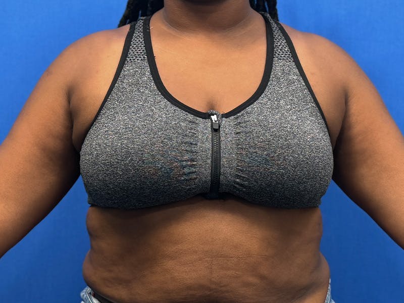 Axillary Breast Removal Before & After Gallery - Patient 112338655 - Image 2