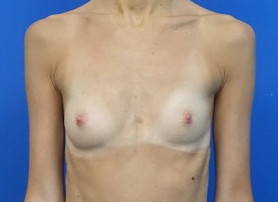 Augmentation Before & After Gallery - Patient 144394 - Image 5