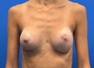 Augmentation Before & After Gallery - Patient 144394 - Image 6