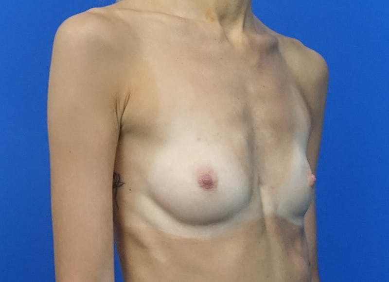 Augmentation Before & After Gallery - Patient 144394 - Image 7