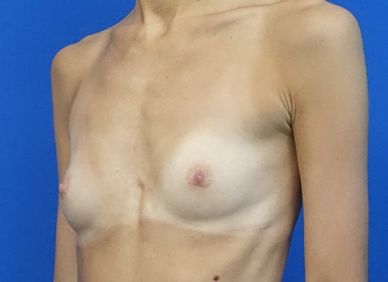 Augmentation Before & After Gallery - Patient 144394 - Image 3