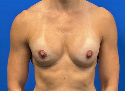 Augmentation Before & After Gallery - Patient 170796 - Image 6