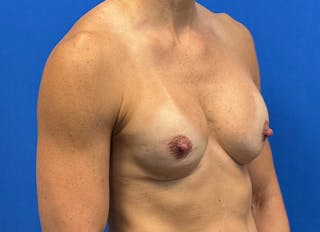 Augmentation Before & After Gallery - Patient 170796 - Image 8