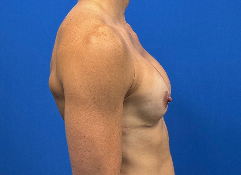 Augmentation Before & After Gallery - Patient 170796 - Image 10