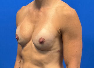 Augmentation Before & After Gallery - Patient 170796 - Image 4