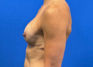 Augmentation Before & After Gallery - Patient 170796 - Image 2