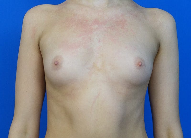 Augmentation Before & After Gallery - Patient 231435 - Image 5