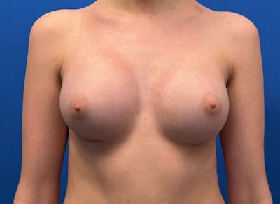 Augmentation Before & After Gallery - Patient 231435 - Image 6