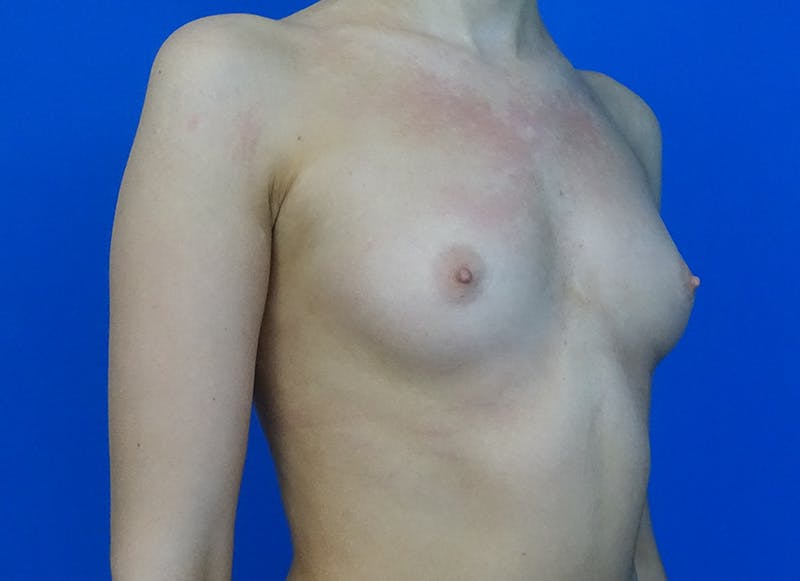 Augmentation Before & After Gallery - Patient 231435 - Image 7
