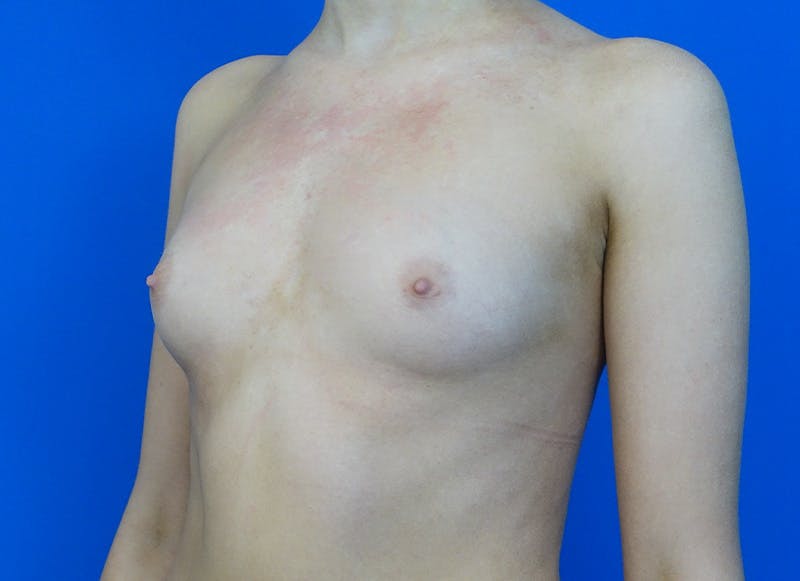 Augmentation Before & After Gallery - Patient 231435 - Image 3