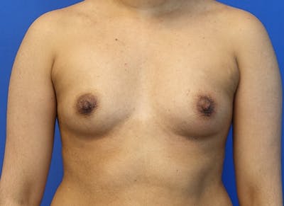 Augmentation Before & After Gallery - Patient 235419 - Image 5