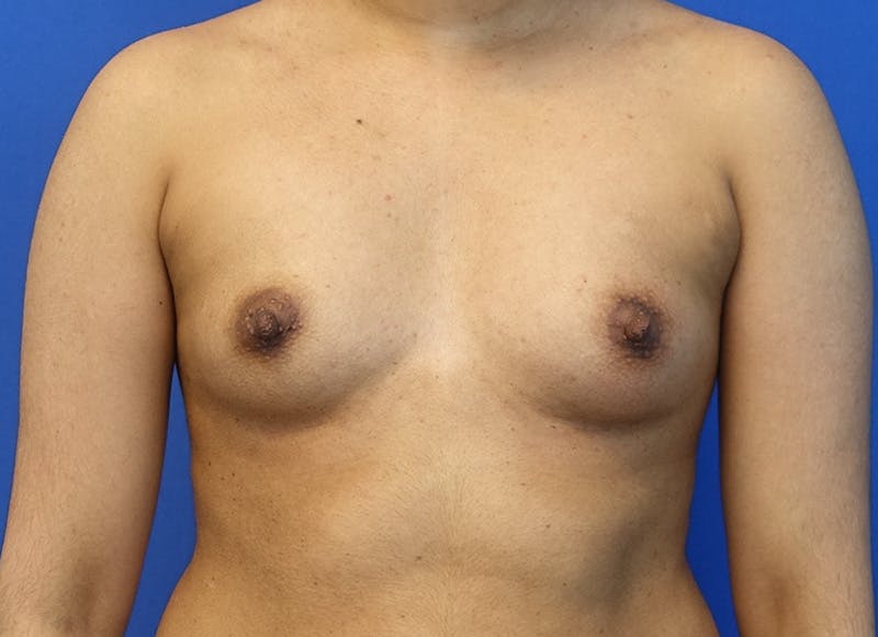 Augmentation Before & After Gallery - Patient 235419 - Image 5