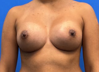 Augmentation Before & After Gallery - Patient 235419 - Image 6