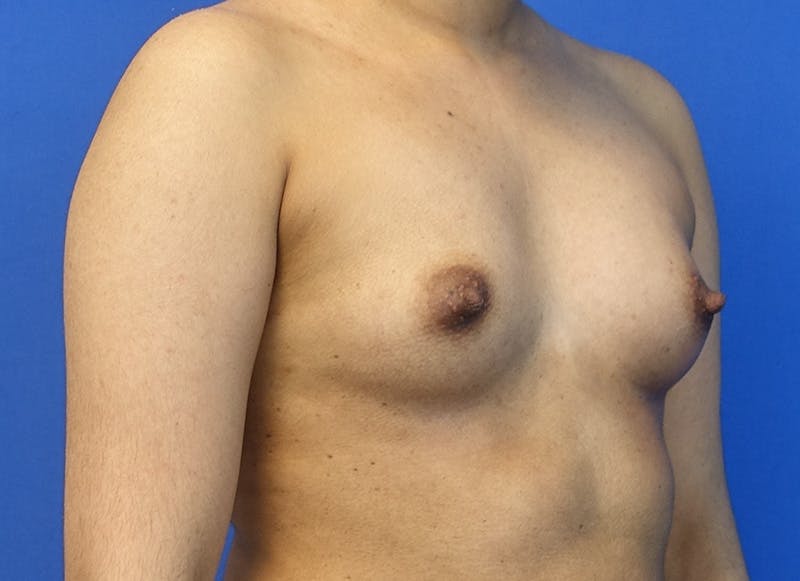 Augmentation Before & After Gallery - Patient 235419 - Image 7
