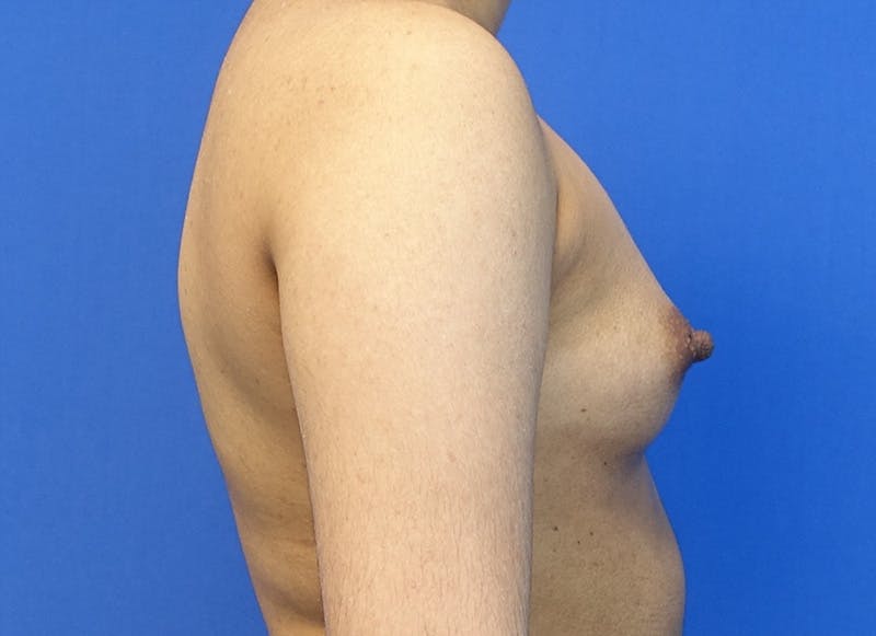 Augmentation Before & After Gallery - Patient 235419 - Image 9