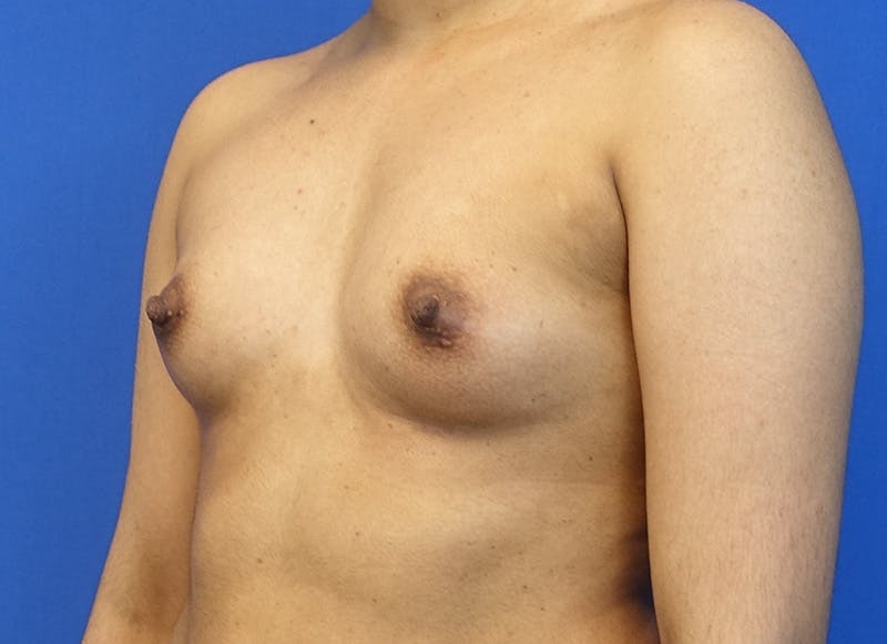 Augmentation Before & After Gallery - Patient 235419 - Image 3