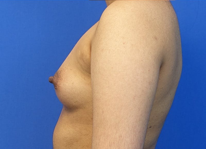 Augmentation Before & After Gallery - Patient 235419 - Image 1