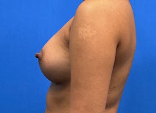 Augmentation Before & After Gallery - Patient 235419 - Image 2