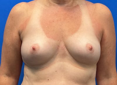 Augmentation Before & After Gallery - Patient 242436 - Image 5