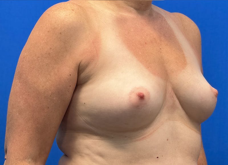 Augmentation Before & After Gallery - Patient 242436 - Image 7