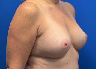 Augmentation Before & After Gallery - Patient 242436 - Image 8