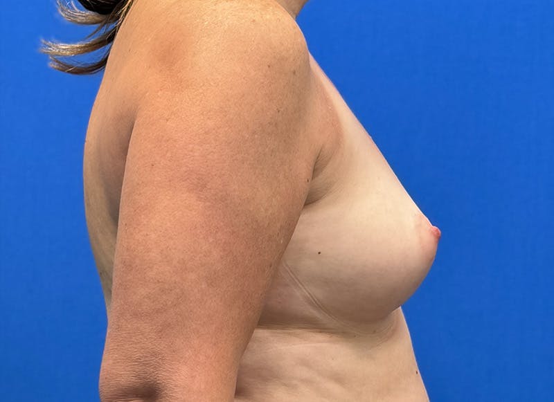 Augmentation Before & After Gallery - Patient 242436 - Image 9