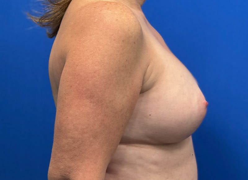 Augmentation Before & After Gallery - Patient 242436 - Image 10