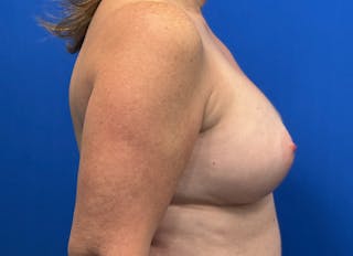 Augmentation Before & After Gallery - Patient 242436 - Image 10