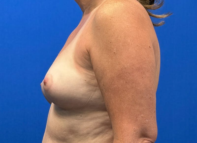 Augmentation Before & After Gallery - Patient 242436 - Image 1