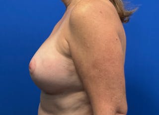 Augmentation Before & After Gallery - Patient 242436 - Image 2