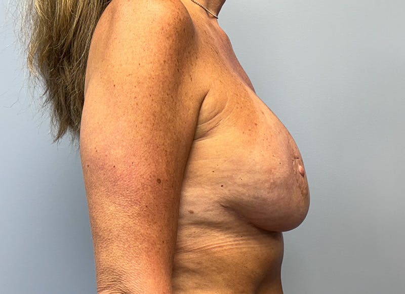 Augmentation Before & After Gallery - Patient 179248822 - Image 9