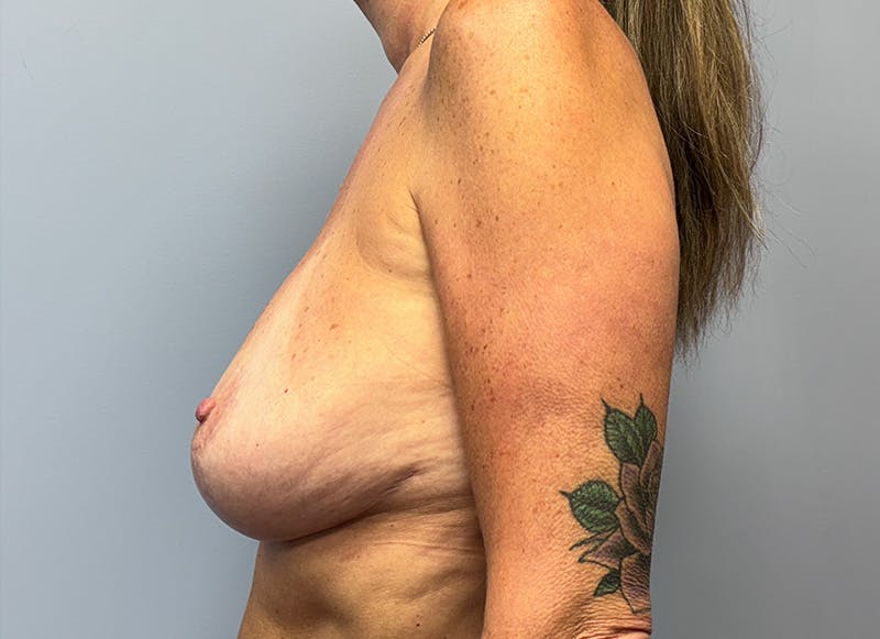 Augmentation Before & After Gallery - Patient 179248822 - Image 1