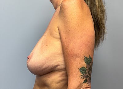 Augmentation Before & After Gallery - Patient 411161 - Image 1
