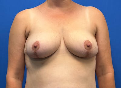 Breast Lift Before & After Gallery - Patient 365718 - Image 6