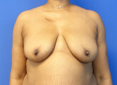 Breast Lift Before & After Gallery - Patient 171189 - Image 5