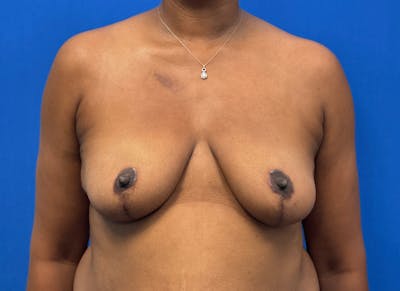 Breast Lift Before & After Gallery - Patient 171189 - Image 6