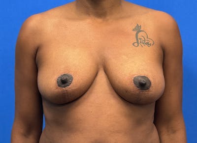 Breast Lift Before & After Gallery - Patient 357195 - Image 6