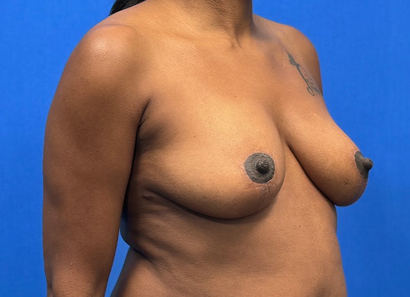Breast Lift Before & After Gallery - Patient 357195 - Image 8