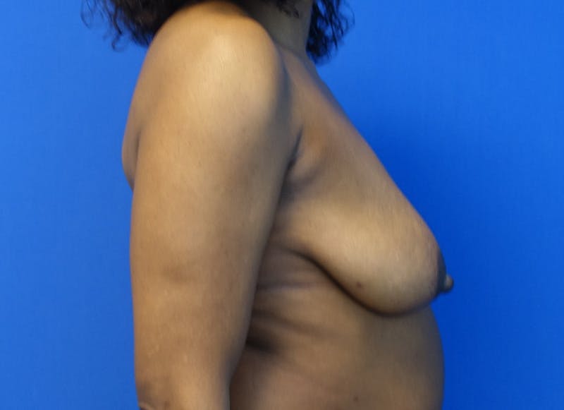 Breast Lift Before & After Gallery - Patient 357195 - Image 9