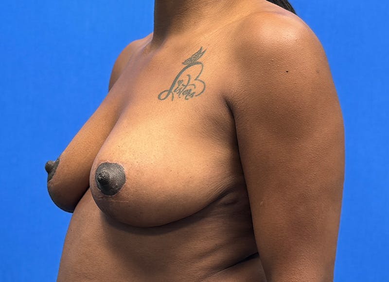 Breast Lift Before & After Gallery - Patient 357195 - Image 4