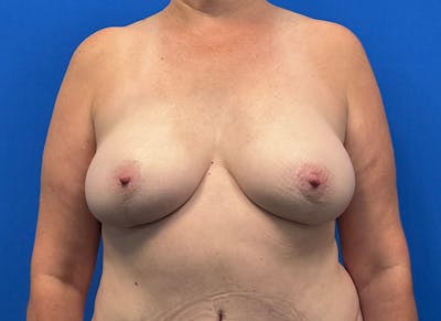 Flap Reconstruction Gallery Before & After Gallery - Patient 185161 - Image 6