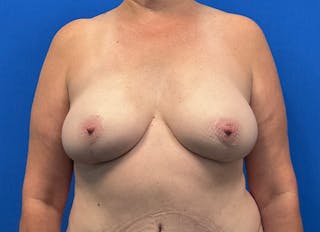 Flap Reconstruction Gallery Before & After Gallery - Patient 185161 - Image 6