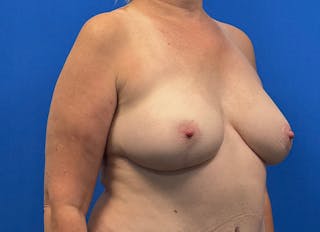 Flap Reconstruction Gallery Before & After Gallery - Patient 185161 - Image 8