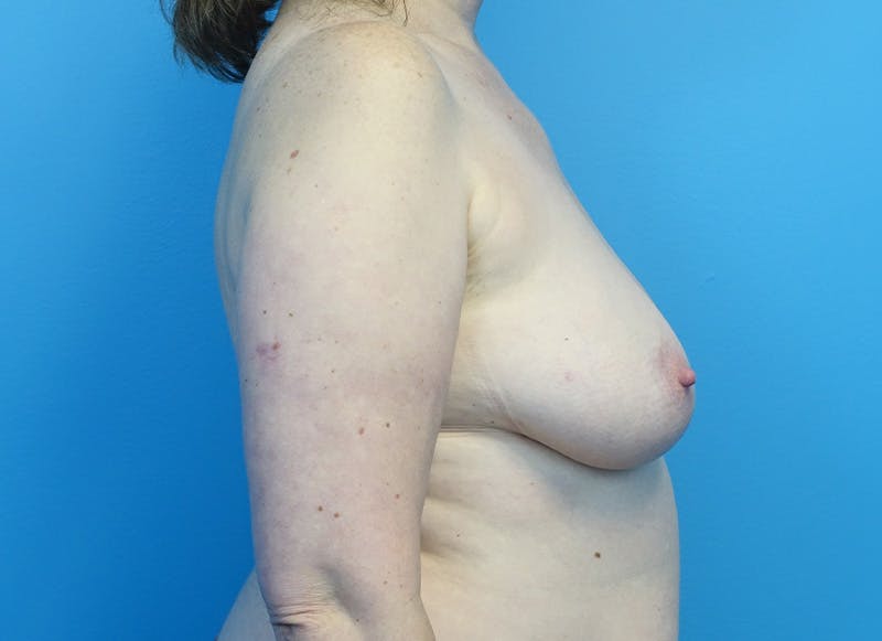 Flap Reconstruction Gallery Before & After Gallery - Patient 185161 - Image 9