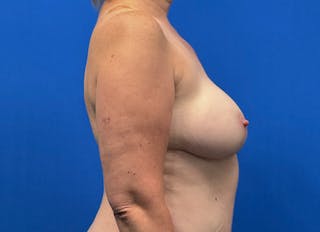 Flap Reconstruction Gallery Before & After Gallery - Patient 185161 - Image 10