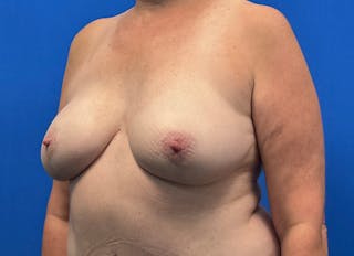 Flap Reconstruction Gallery Before & After Gallery - Patient 185161 - Image 4