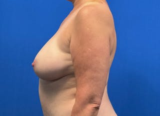 Flap Reconstruction Gallery Before & After Gallery - Patient 185161 - Image 2