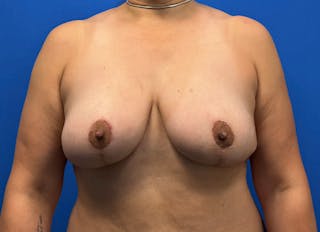 Flap Reconstruction Gallery Before & After Gallery - Patient 573884 - Image 6